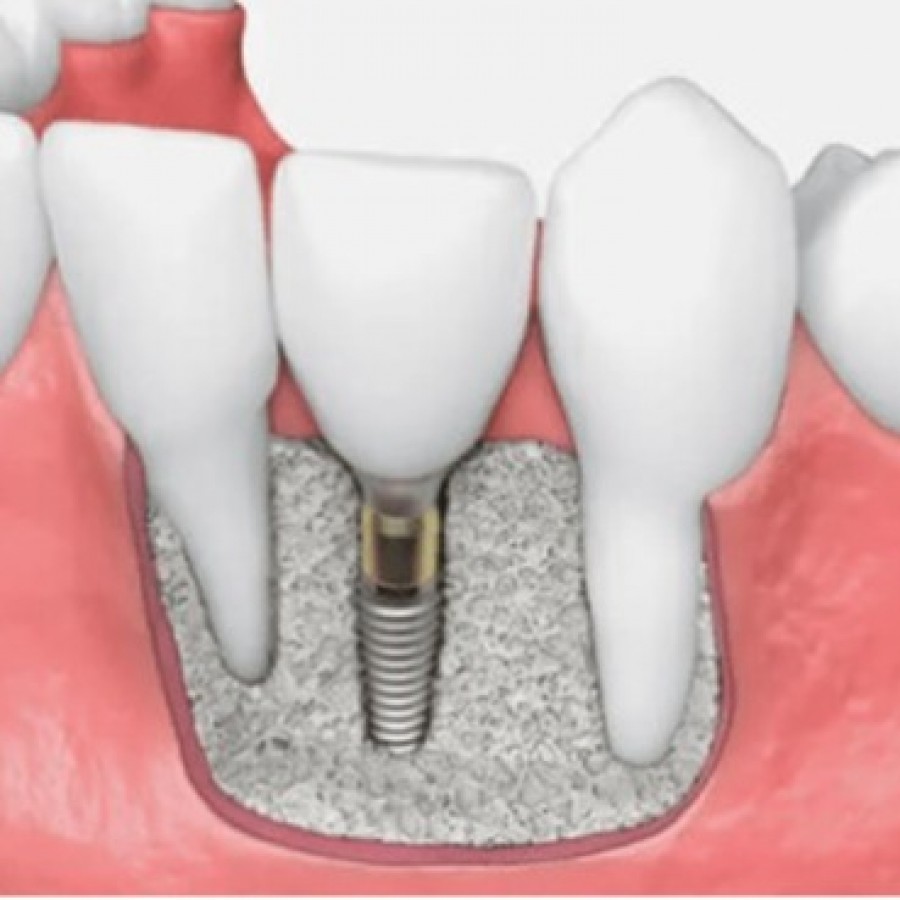 Dental Bone Graft Recovery Luxden Dental Center 3271