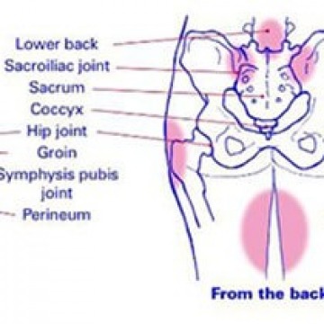 Pelvic Pain