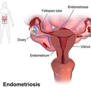 Endometriosis specialist