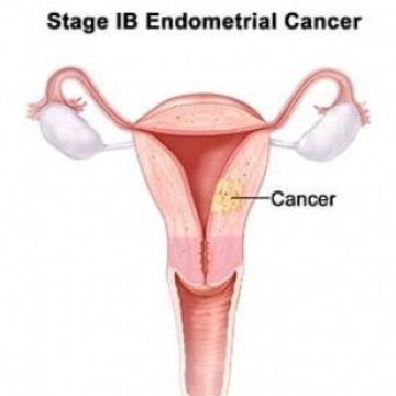 Endometriosis specialist