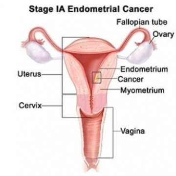 Endometriosis specialist