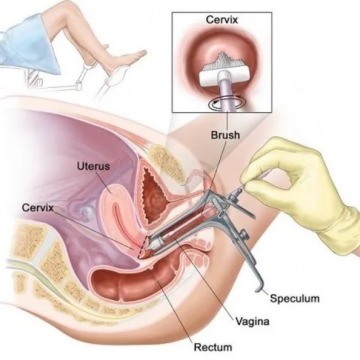 Cervical Biopsy Procedure