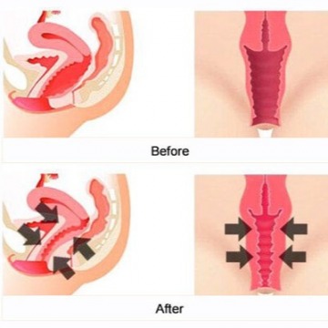 Vaginoplasty procedure