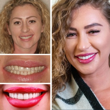 Cosmetic Dentistry in Brooklyn NYC