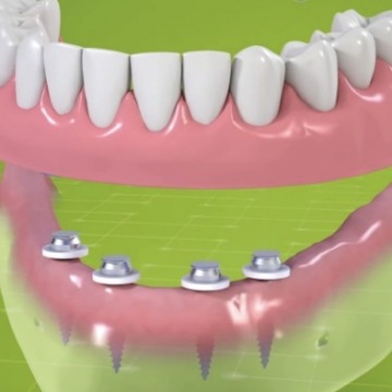 Mini Dental Implants