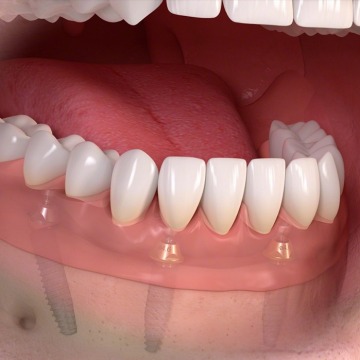 Affordable dental implants NYC