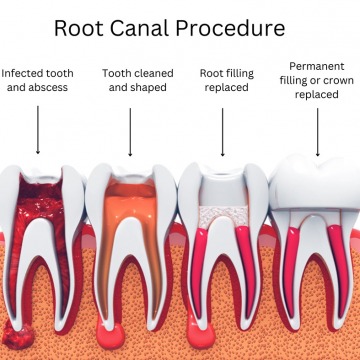 Root canal treatment