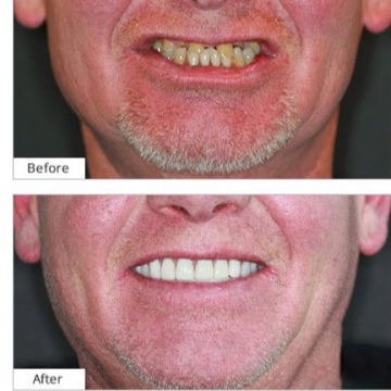 Dental Implants