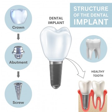 Dental Implants