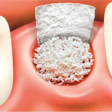 Dental bone graft cost