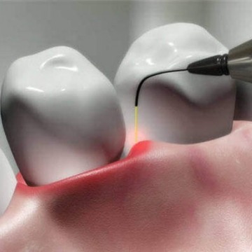 Laser Gum Surgery