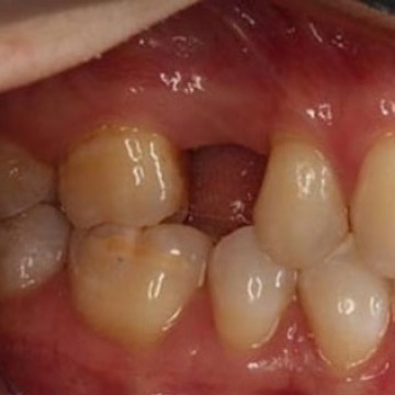 Dental implant procedure