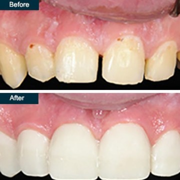 Smile makeover cost