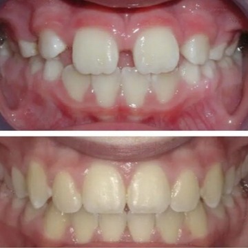 Invisalign orthodontist