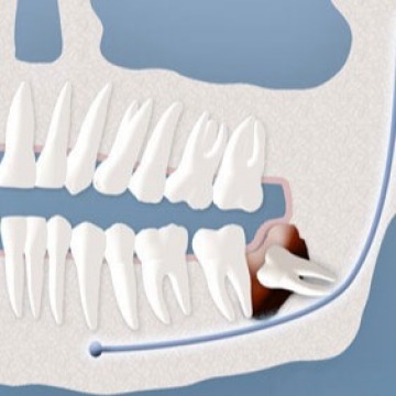 Wisdom teeth removal NJ