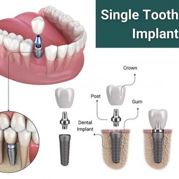 Single tooth implants in NJ