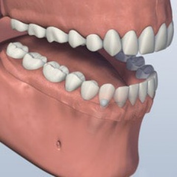 Full mouth dental implant in NJ