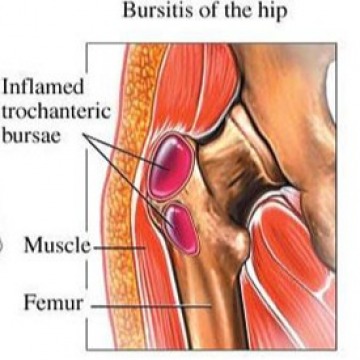 Hip Pain Treatment In NYC