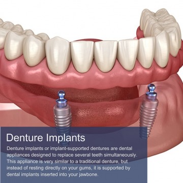 Implant denture in NY