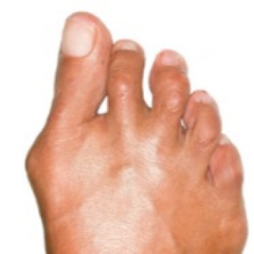 Bunion Surgery Specialists NY