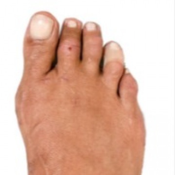 Bunion Surgery Specialists NY