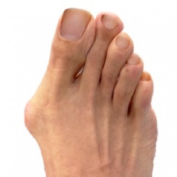 Bunion Surgery Specialists NY