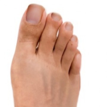 Bunion Surgery Specialists NY