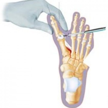 Minimally invasive foot surgery in NYC