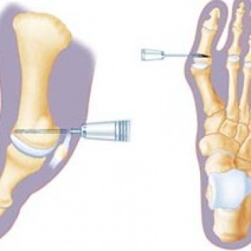 Minimally invasive foot surgery in NYC