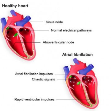 Atrial Fibrillation Treatment in NYC