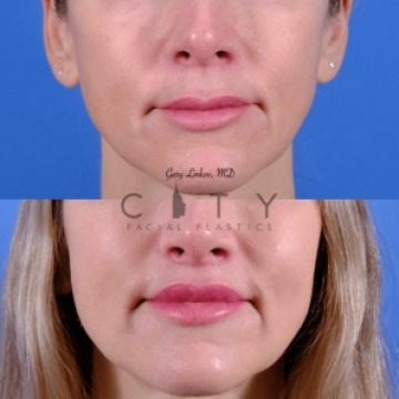 Bullhorn Lip Lift in NYC