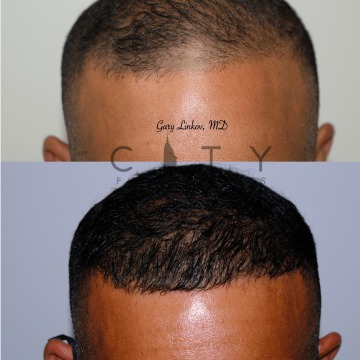 Best hair transplant NYC