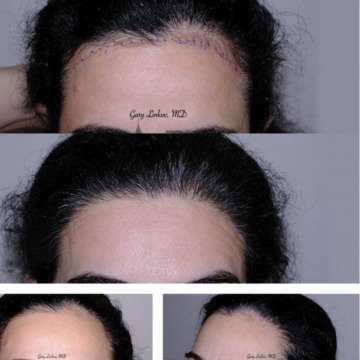 Womens hair loss treatment in NYC