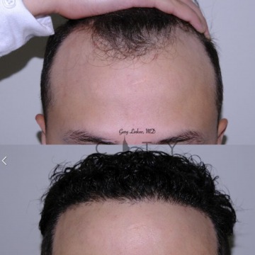 Hair Transplants in NYC