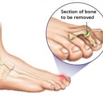 Hammer Toe Surgery in NJ