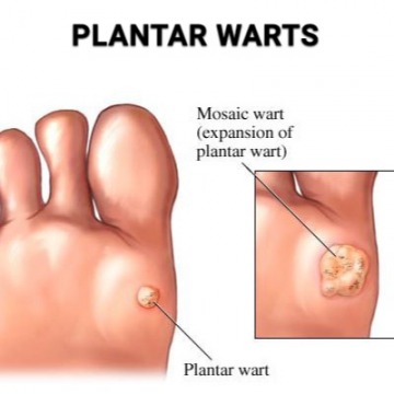 Plantar warts treatment in Wayne, NJ