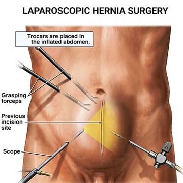 Laparoscopic Hernia Surgery