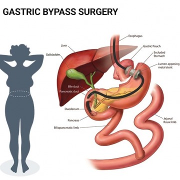 Gastric bypass surgery