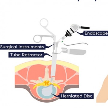 Minimally invasive spine surgery in NJ