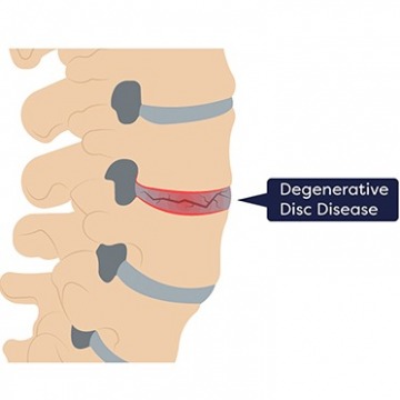 ARTIFICIAL DISC REPLACEMENT SURGERY NJ