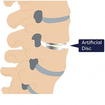 ARTIFICIAL DISC REPLACEMENT SURGERY NJ