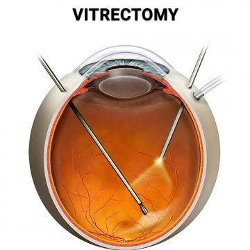 Diabetic retinopathy vitrectomy in NYC