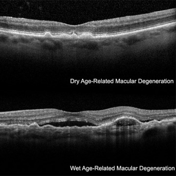 Macular Hole in New York