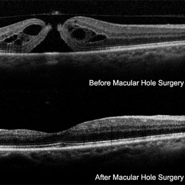 Macular Hole in New York