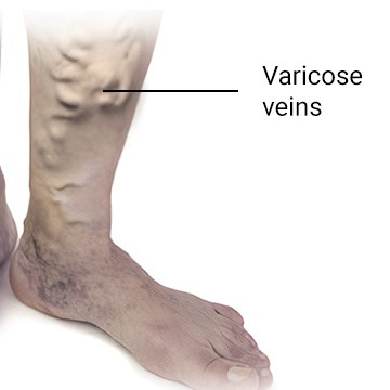 Vein Treatments in Brooklyn