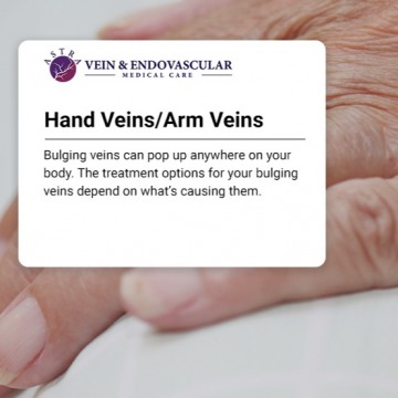 Hand vein treatment in Bronx