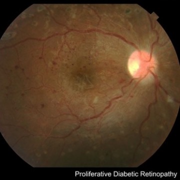 Diabetic Retinopathy in Manhattan, NY