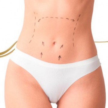 Tummy Tuck (Abdominoplasty)