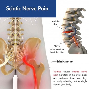 Sciatica Treatment in Madison, WI